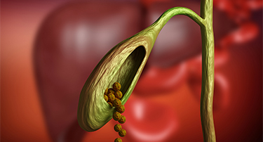 Can Gallbladder Stones Be Removed Without Surgery?