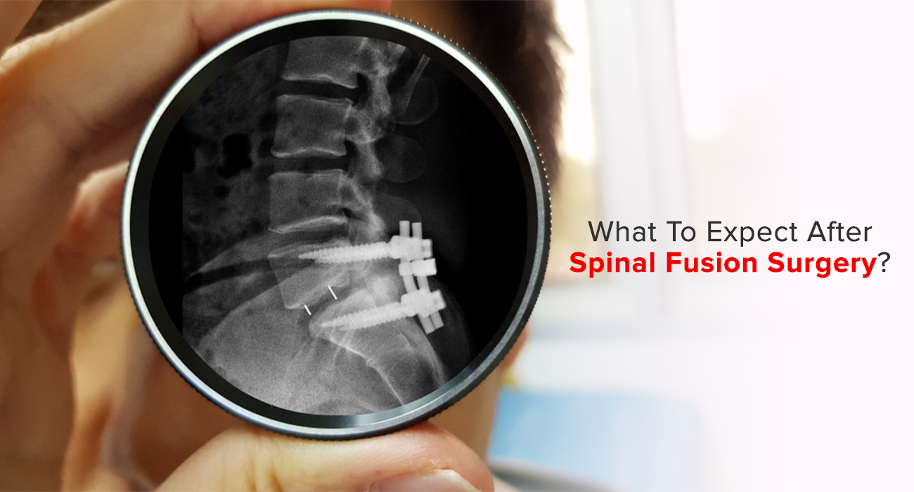 What To Expect After Spinal Fusion Surgery?