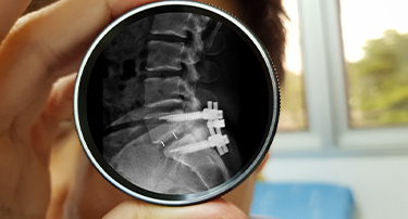 What To Expect After Spinal Fusion Surgery?