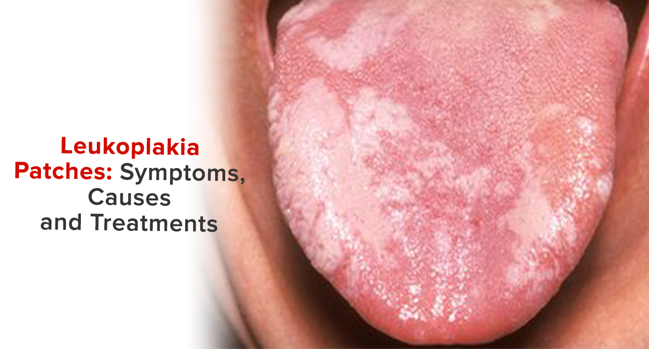 Leukoplakia Patches: Symptoms, Causes and Treatments