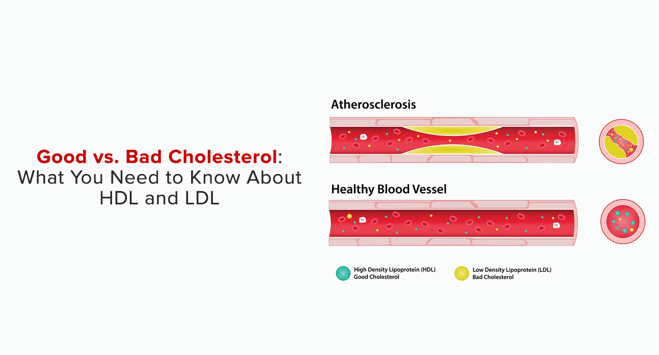 Good vs. Bad Cholesterol: What You Need To Know About HDL And LDL