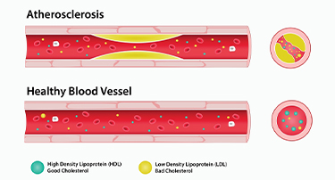 Good vs. Bad Cholesterol: What You Need To Know About HDL And LDL