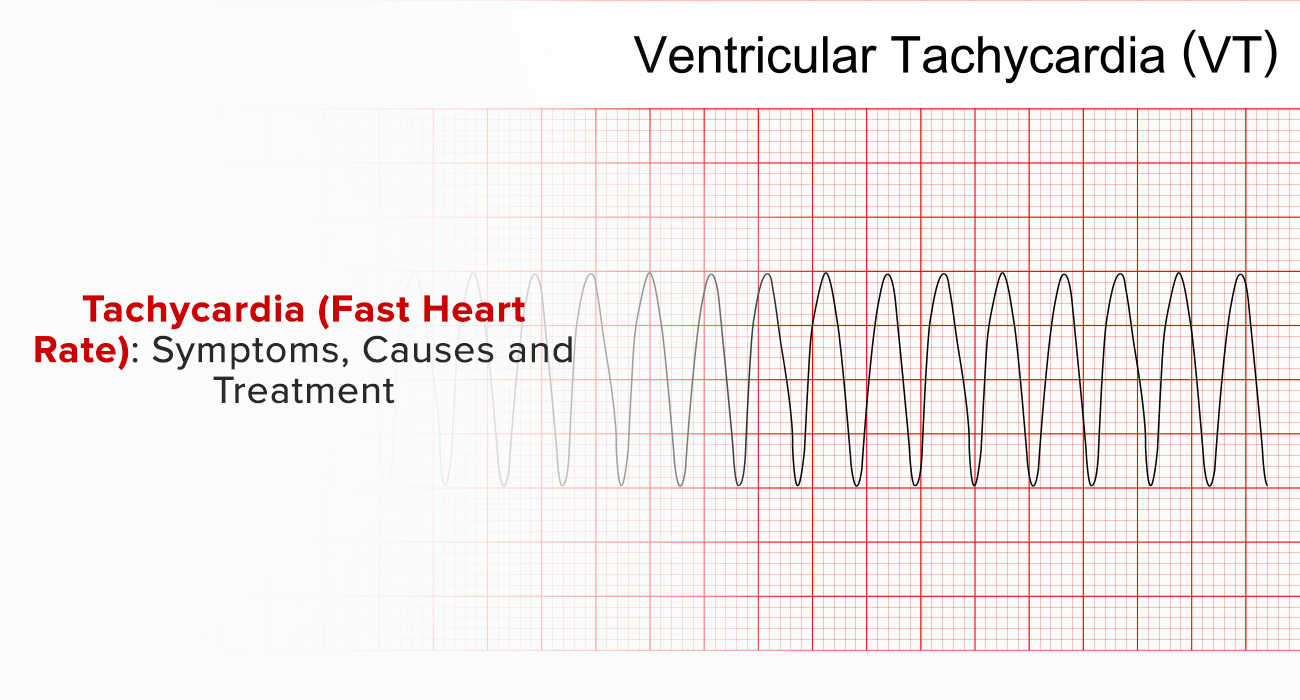 Tachycardia (Fast Heart Rate): Symptoms, Causes And Treatment