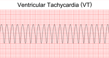 Tachycardia (Fast Heart Rate): Symptoms, Causes And Treatment