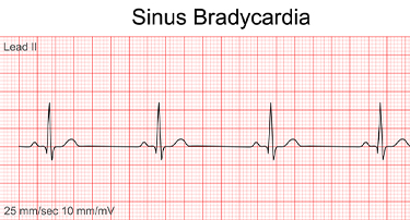 Bradycardia: Causes, Symptoms And Treatment Of Low Heart Rate