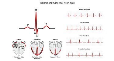 Heart Attack vs. Normal ECG: Key Differences You Should Know