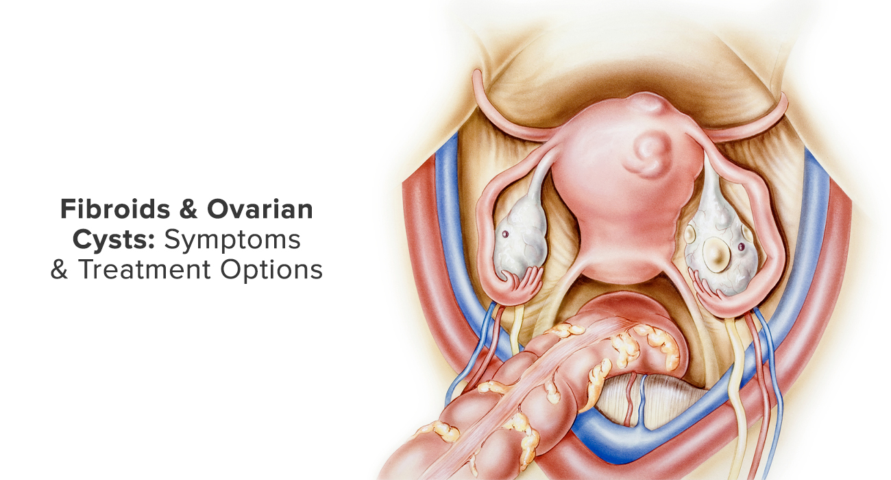 Fibroids & Ovarian Cysts: Symptoms & Treatment Options