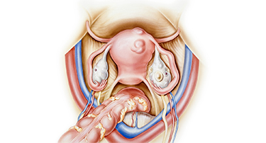 Fibroids & Ovarian Cysts: Symptoms & Treatment Options