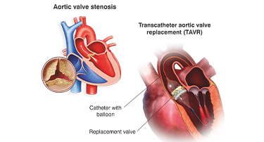 Who Is The Ideal Candidate For TAVI? Understanding Eligibility & Benefits